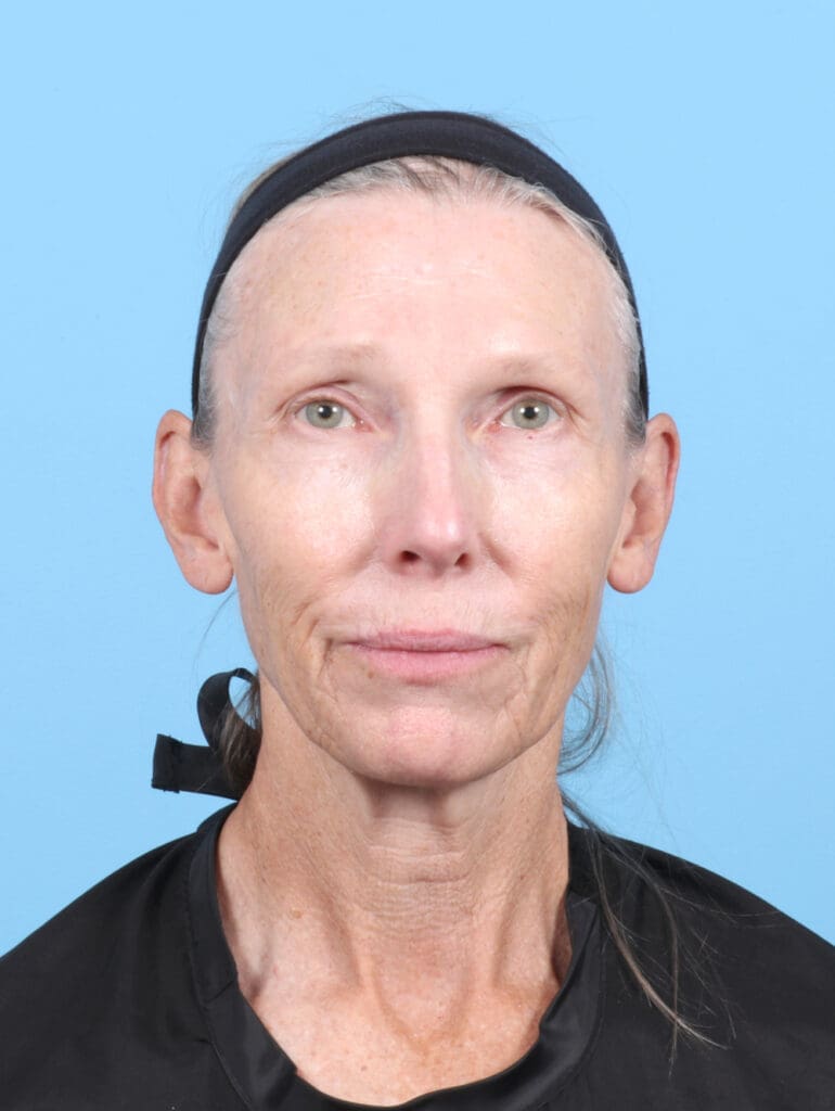 Facelift - Case 6725 - Before