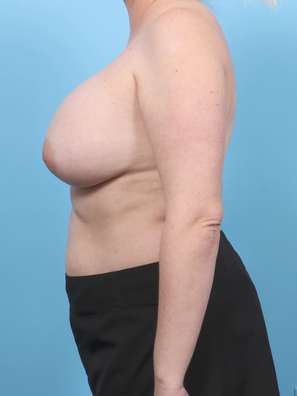 Breast Augmentation Patient Photo - Case 6759 - after view-2