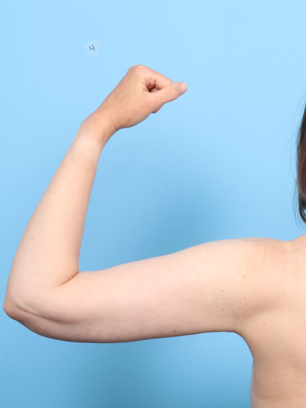 Arm Lift Patient Photo - Case 6927 - after view