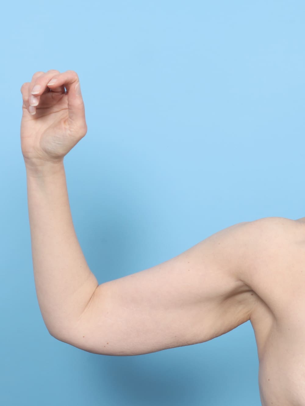 Arm Lift Patient Photo - Case 6927 - before view-1