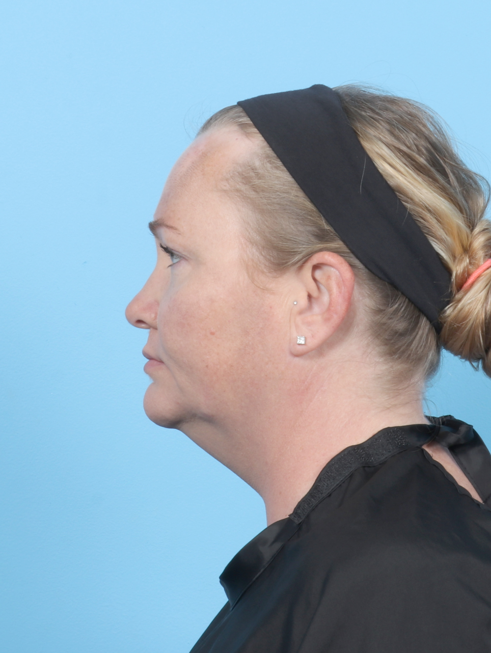 Facial Liposuction Patient Photo - Case 6998 - before view-2