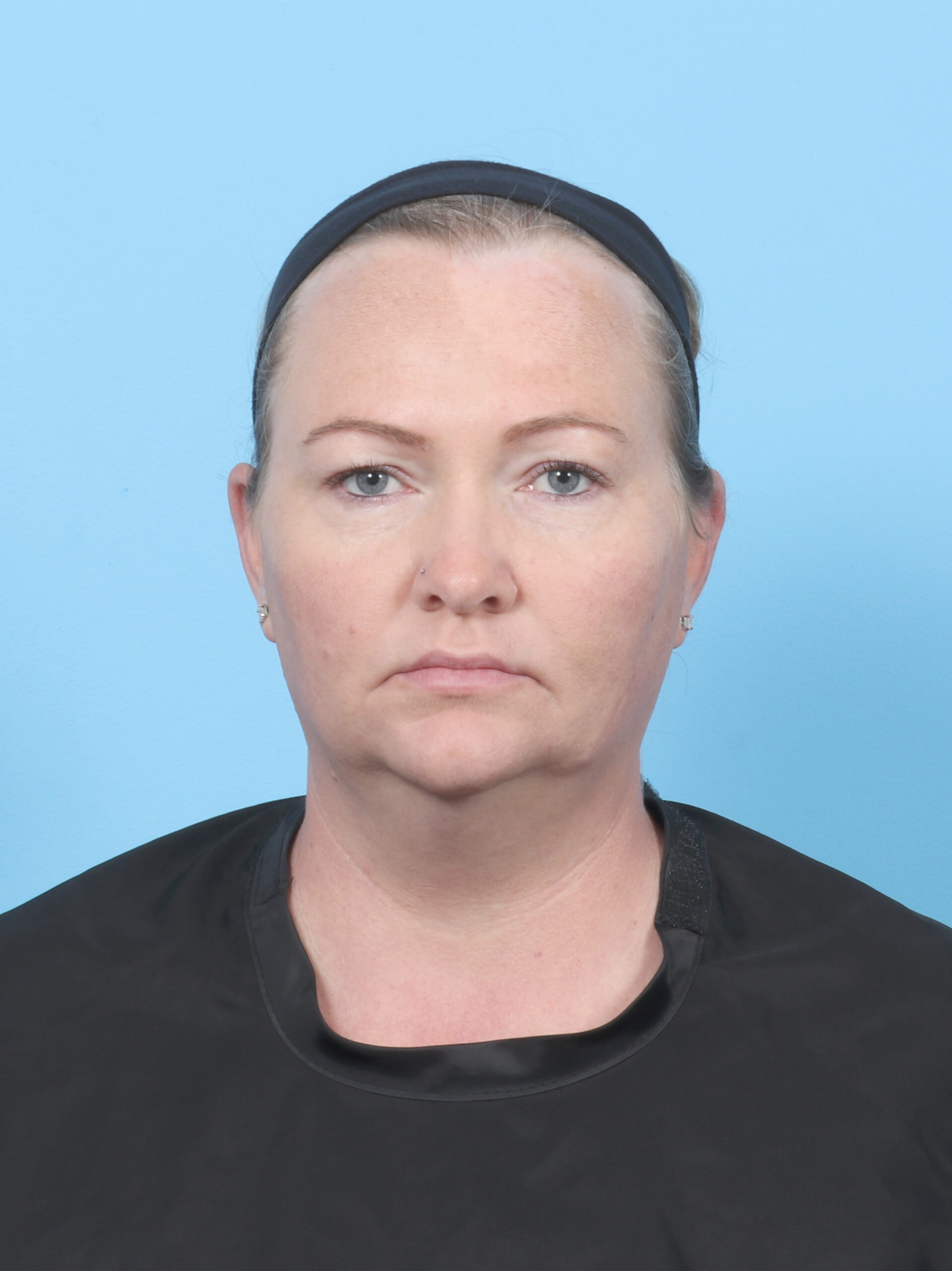 Facial Liposuction Patient Photo - Case 6998 - before view-