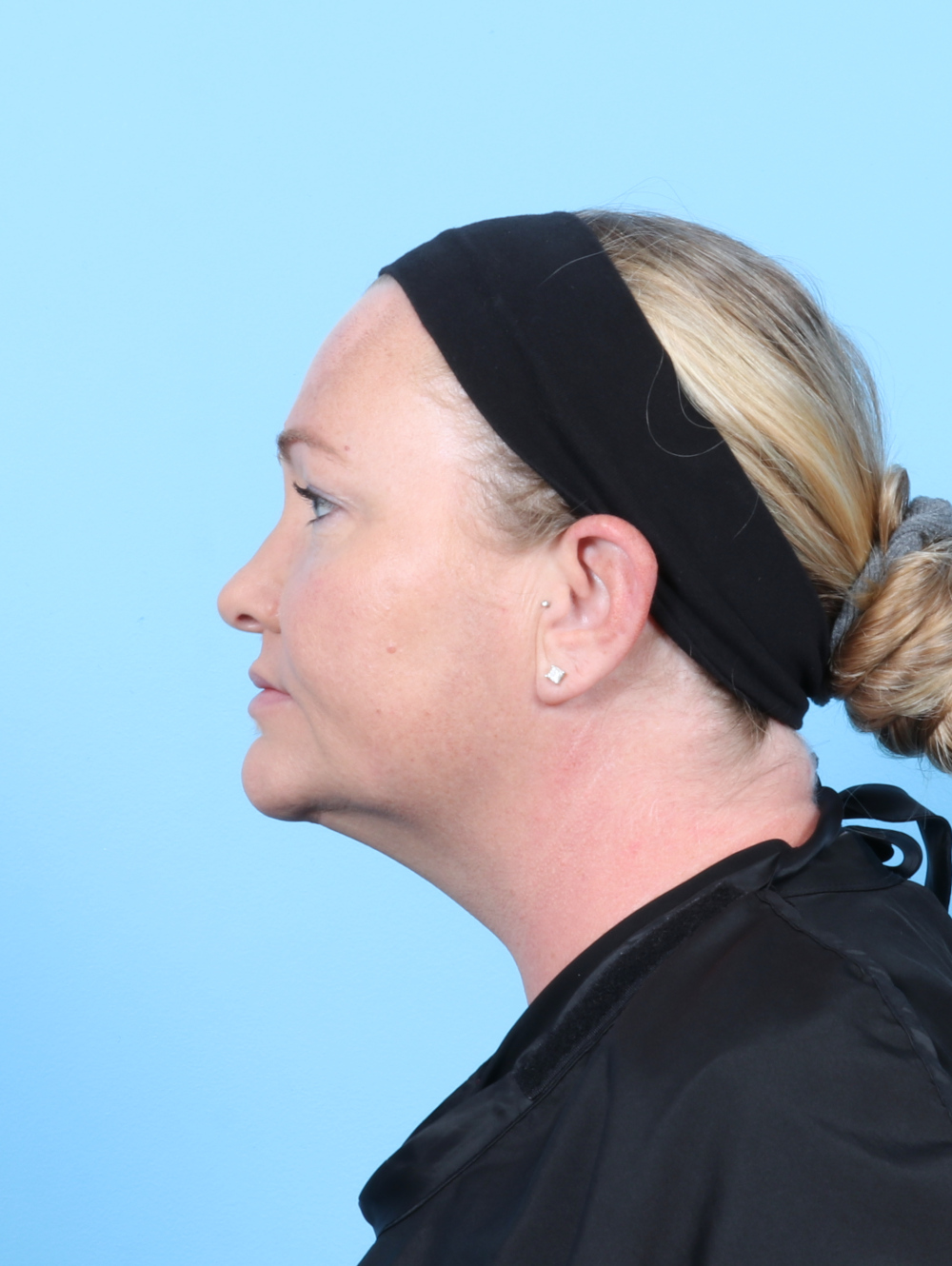 Facial Liposuction Patient Photo - Case 6998 - after view-2