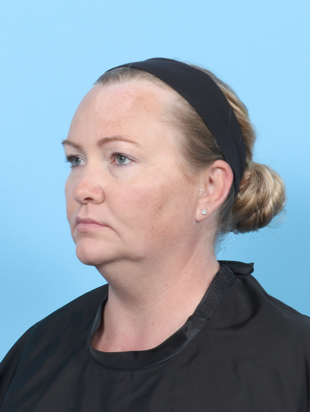 Facial Liposuction Patient Photo - Case 6998 - before view-1