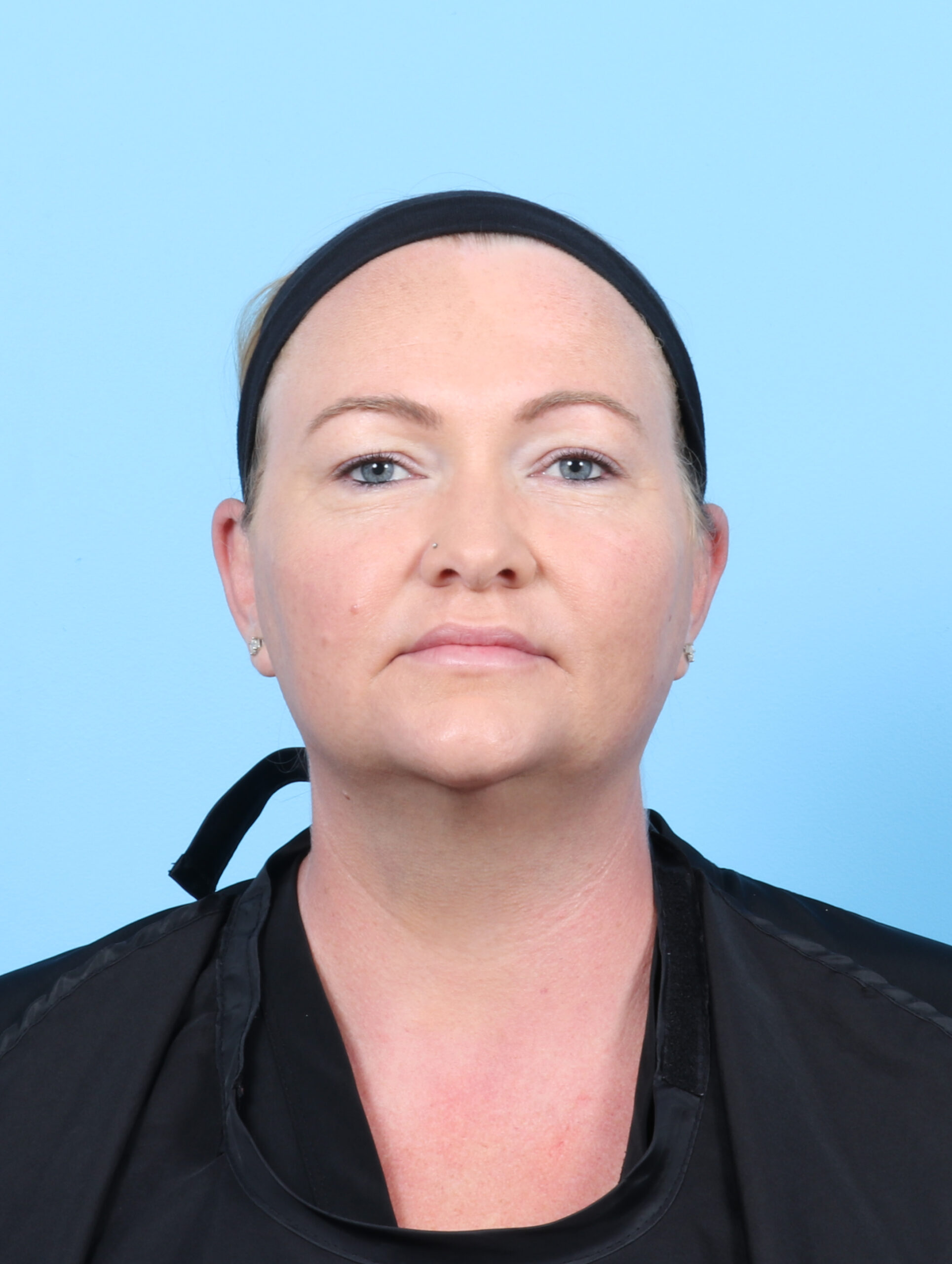 Facial Liposuction Patient Photo - Case 6998 - after view