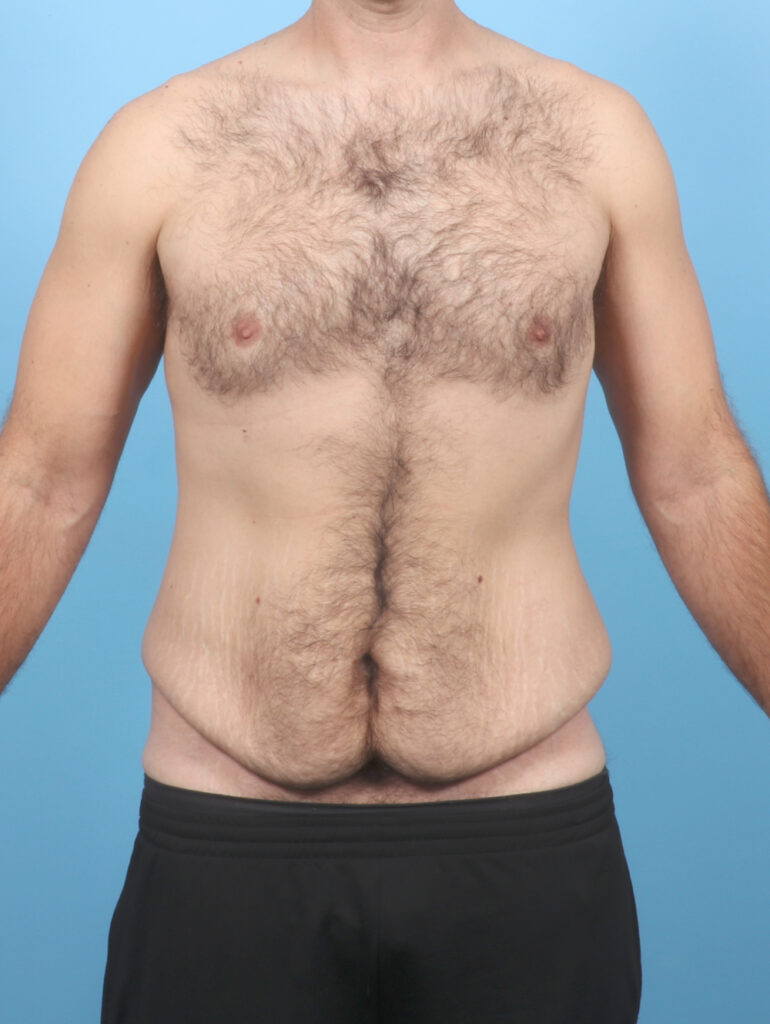 Body Lift - Case 7024 - Before