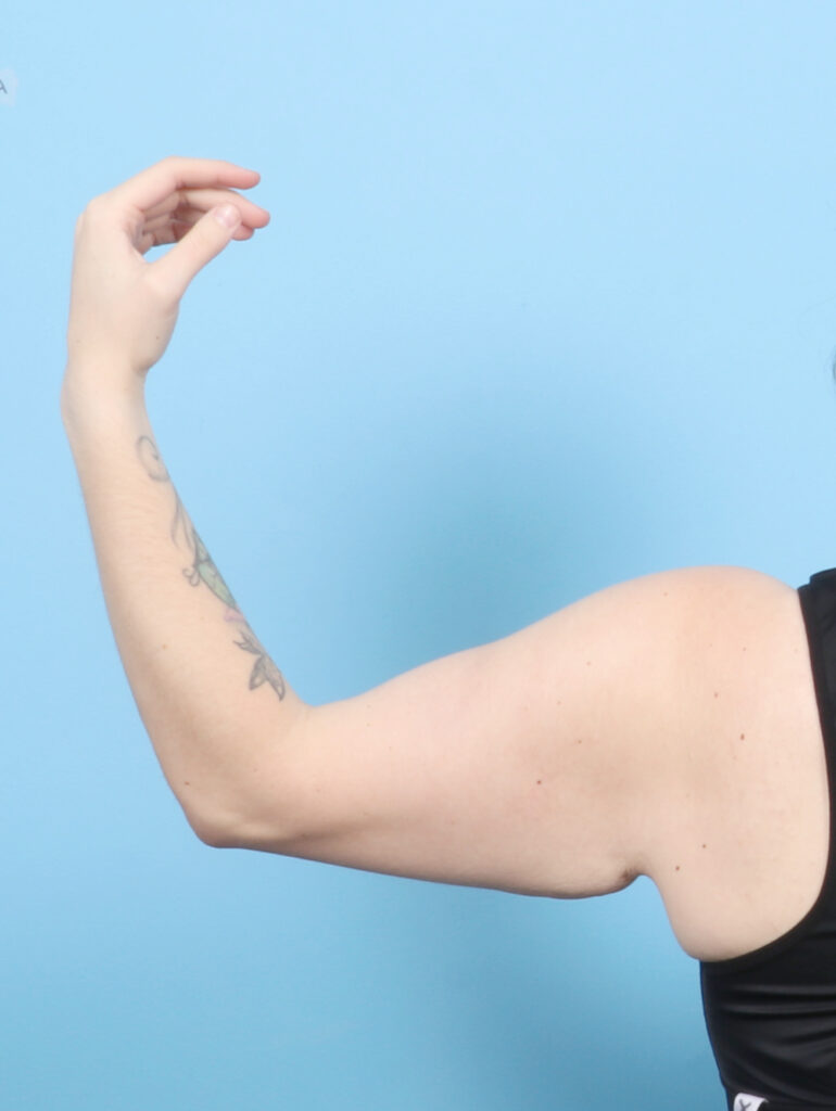 Arm Lift - Case 7032 - Before