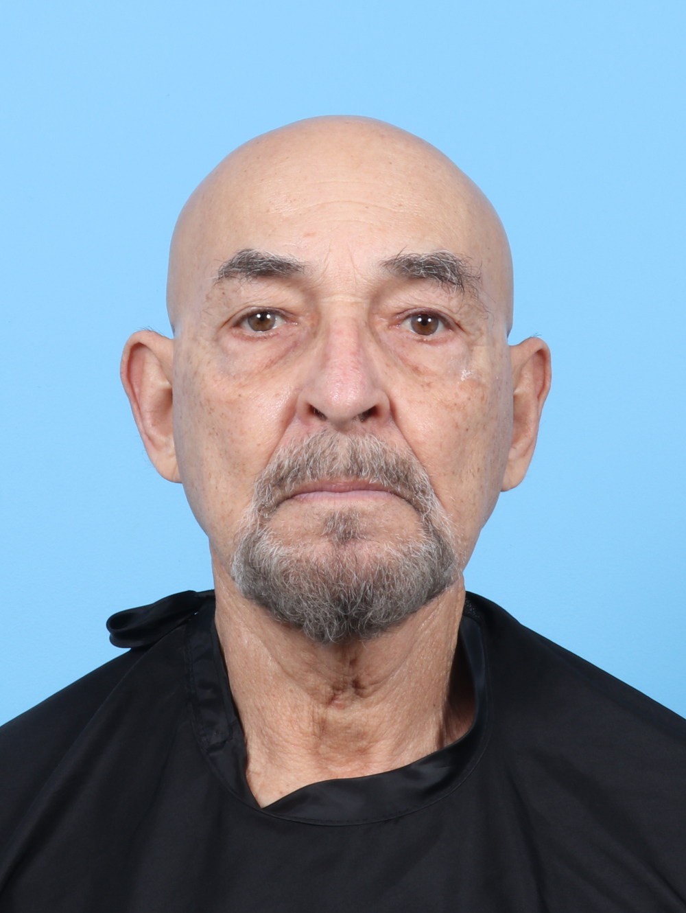 Eyelid Surgery Patient Photo - Case 7062 - before view-