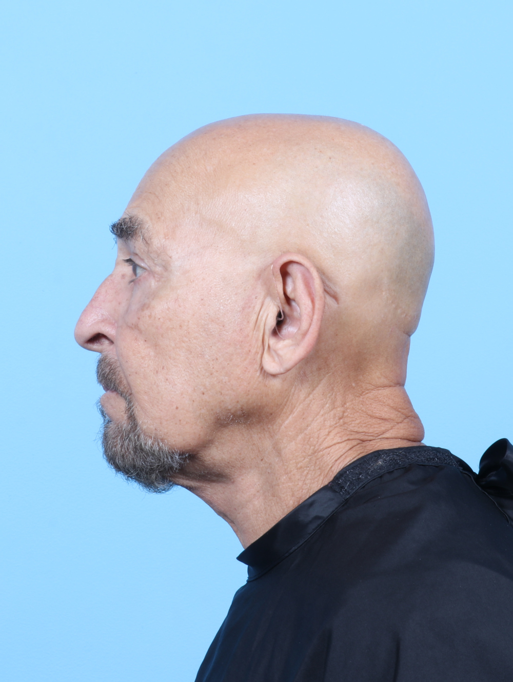 Eyelid Surgery Patient Photo - Case 7062 - after view-2