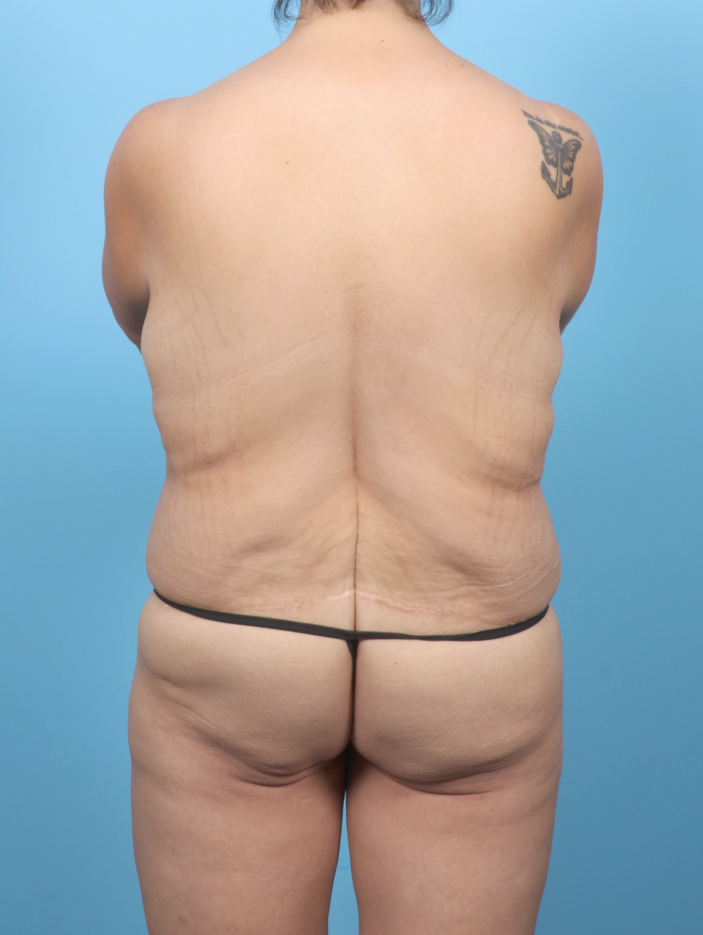 Breast Augmentation Patient Photo - Case 7078 - before view-3