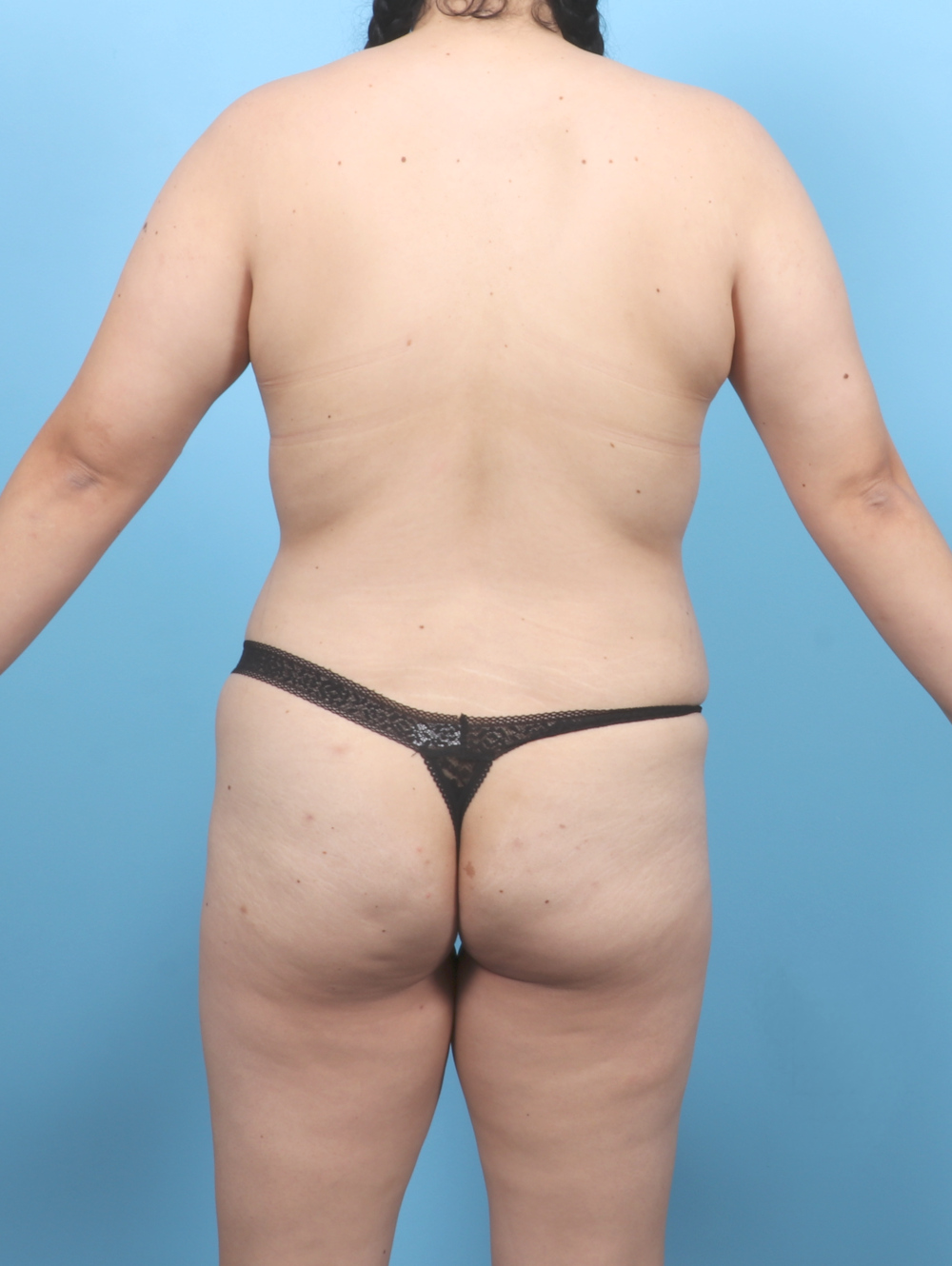 Liposuction Patient Photo - Case 7104 - before view-3