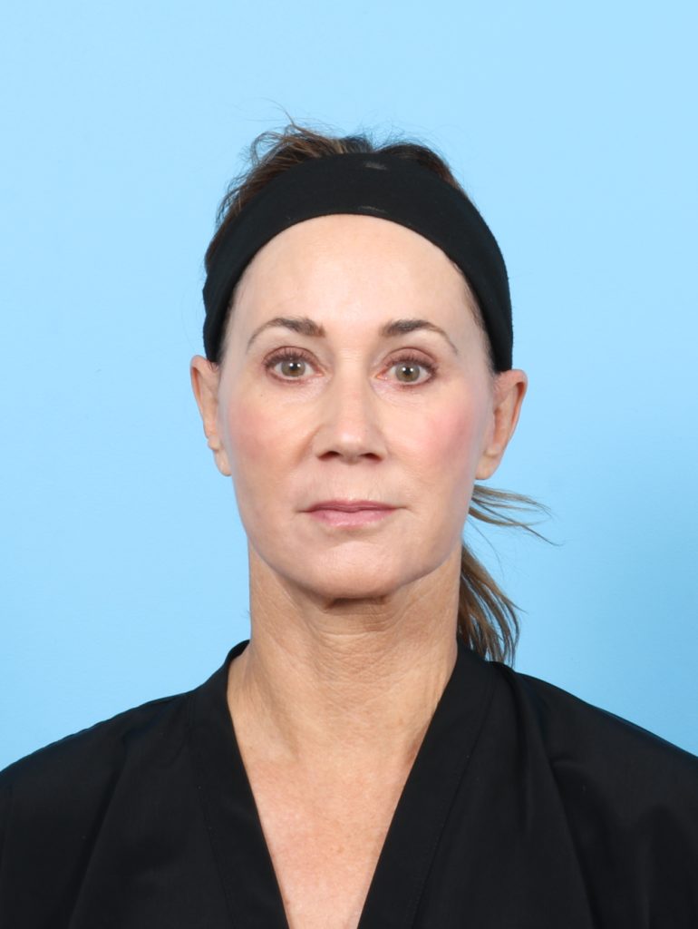 Facelift - Case 7313 - After