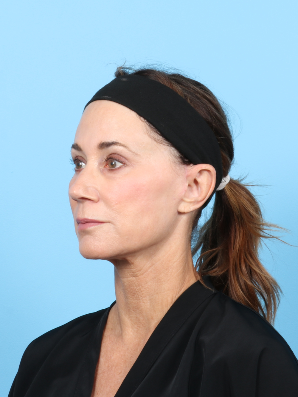 Facelift Patient Photo - Case 7313 - after view-2