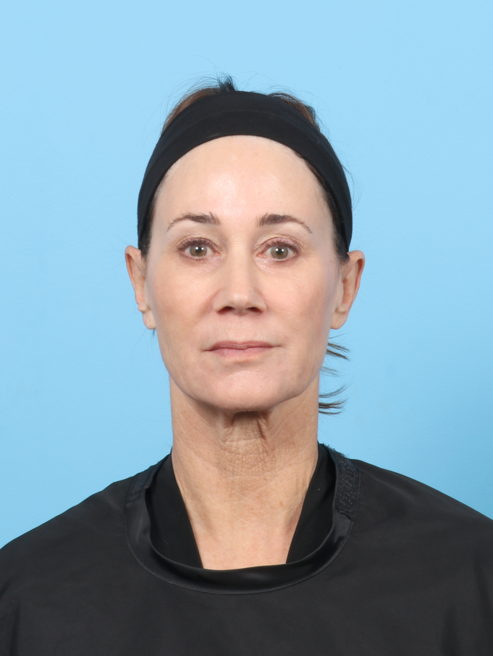 Facelift Patient Photo - Case 7313 - before view-