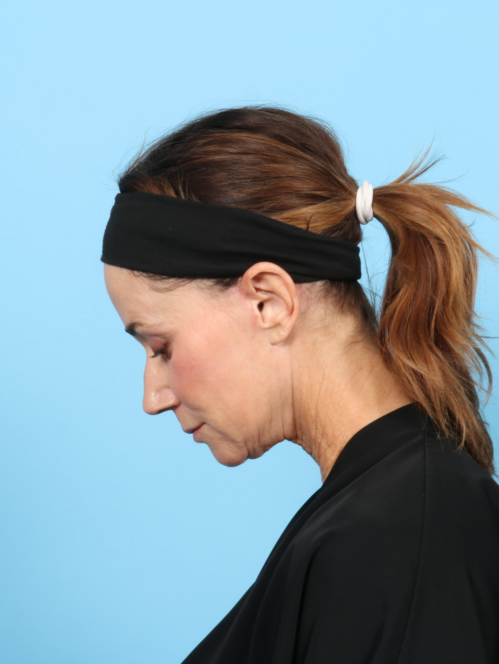 Facelift Patient Photo - Case 7313 - after view-1