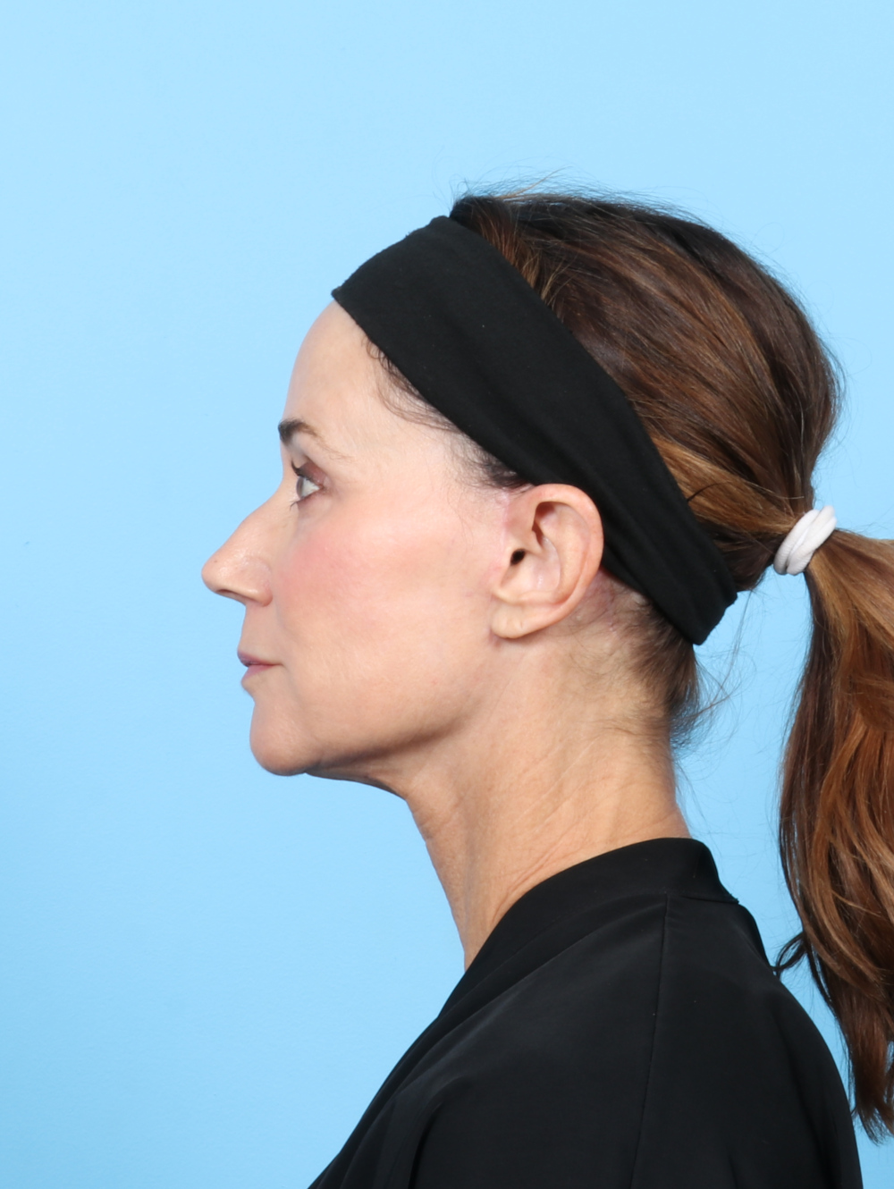 Facelift Patient Photo - Case 7313 - after view-3