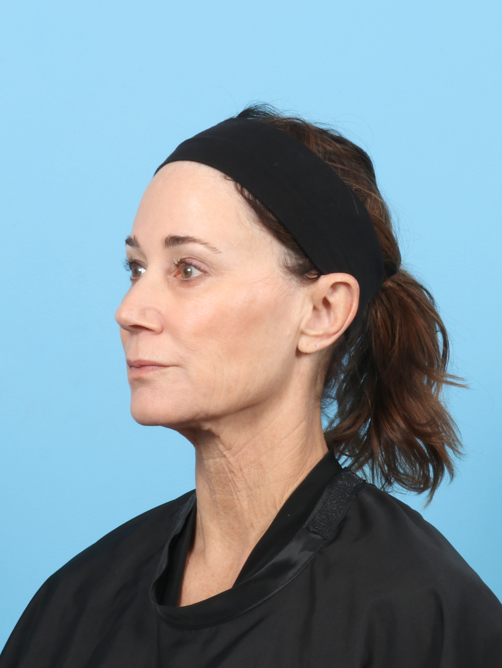 Facelift Patient Photo - Case 7313 - before view-2