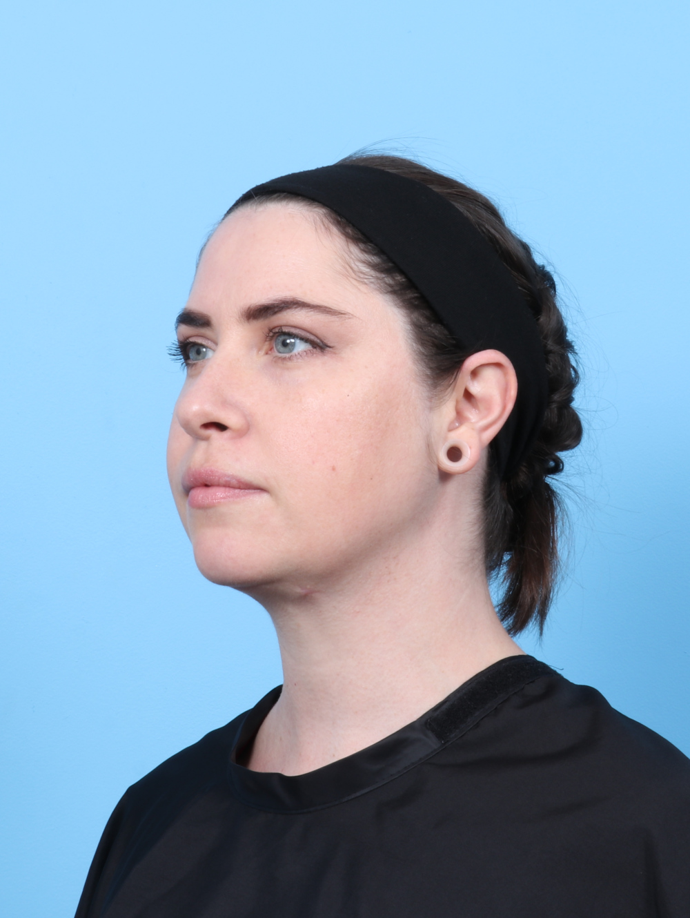 Anterior Neck Lift Patient Photo - Case 7372 - after view-3