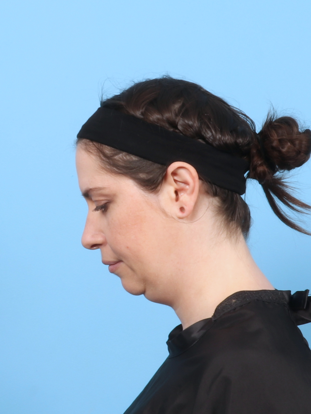 Anterior Neck Lift Patient Photo - Case 7372 - before view-1