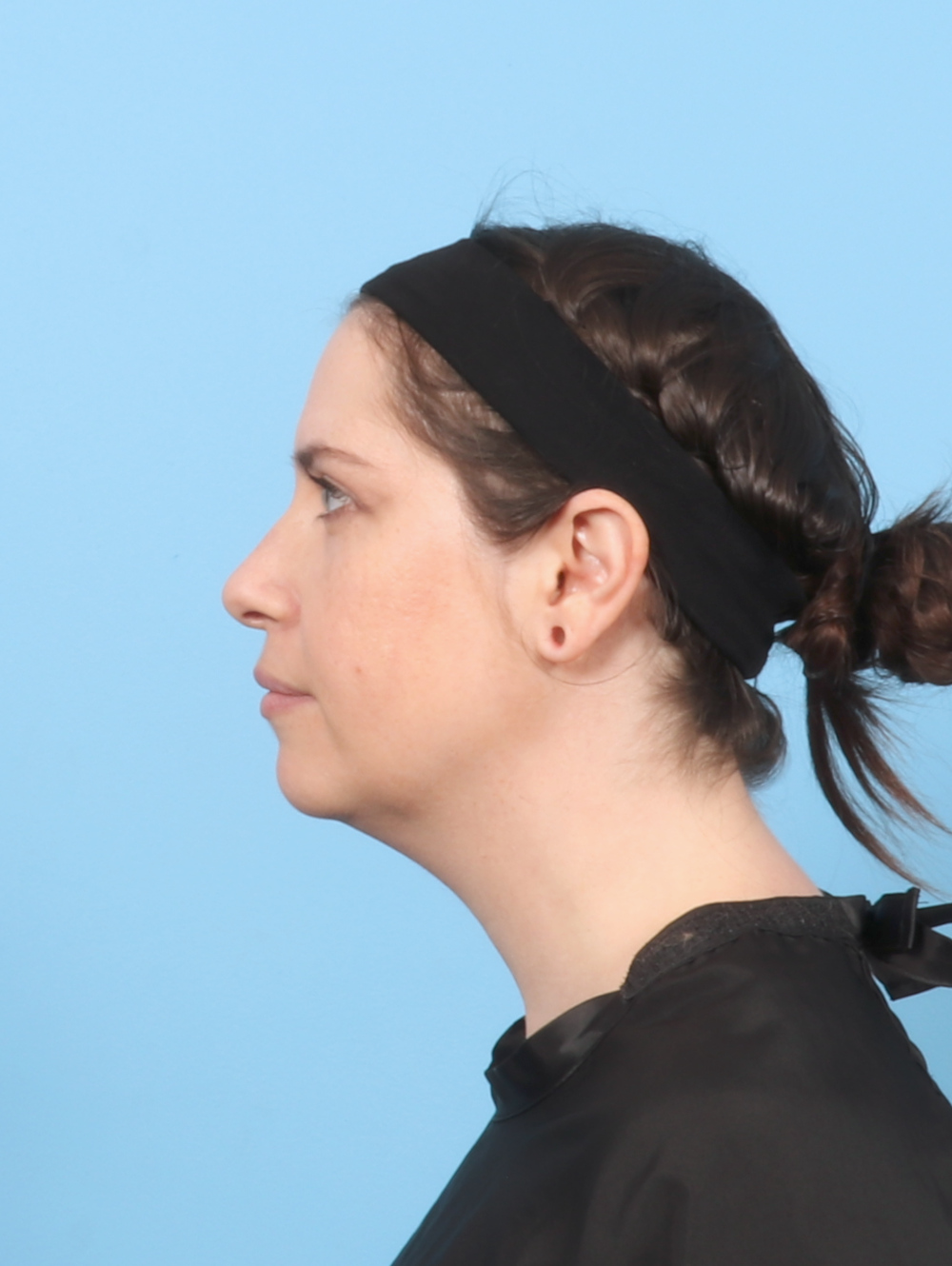 Anterior Neck Lift Patient Photo - Case 7372 - before view-