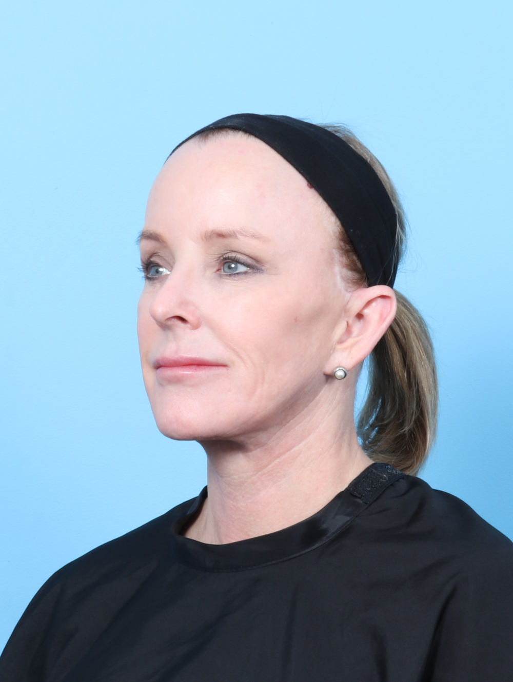 Eyelid Surgery Patient Photo - Case 7429 - after view-1