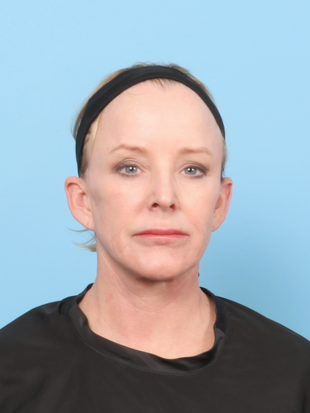 Eyelid Surgery Patient Photo - Case 7429 - before view-