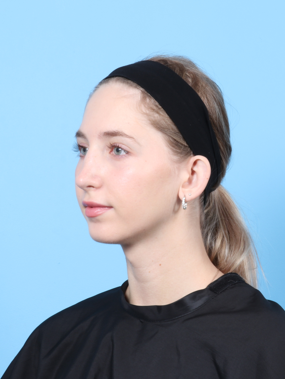 Rhinoplasty Patient Photo - Case 7477 - after view-2