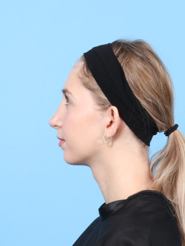 Rhinoplasty - Case 7477 - After