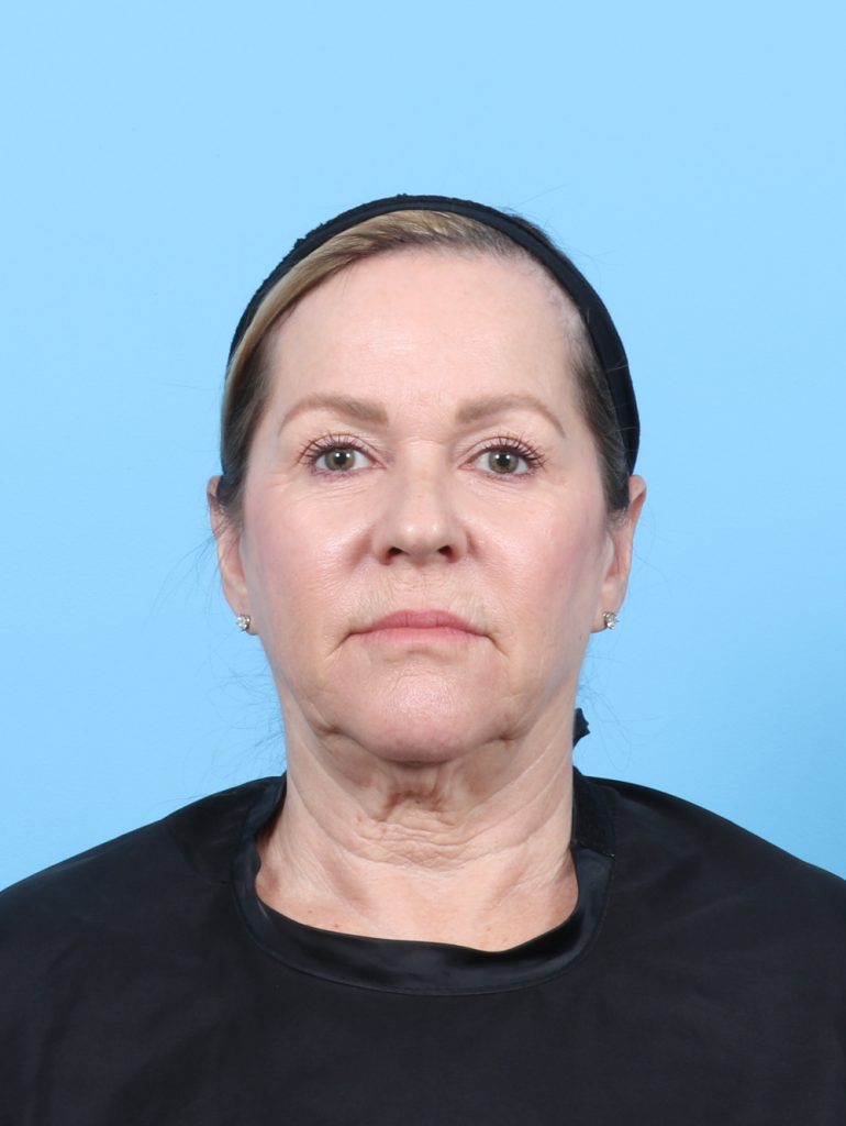 Facelift - Case 7509 - Before