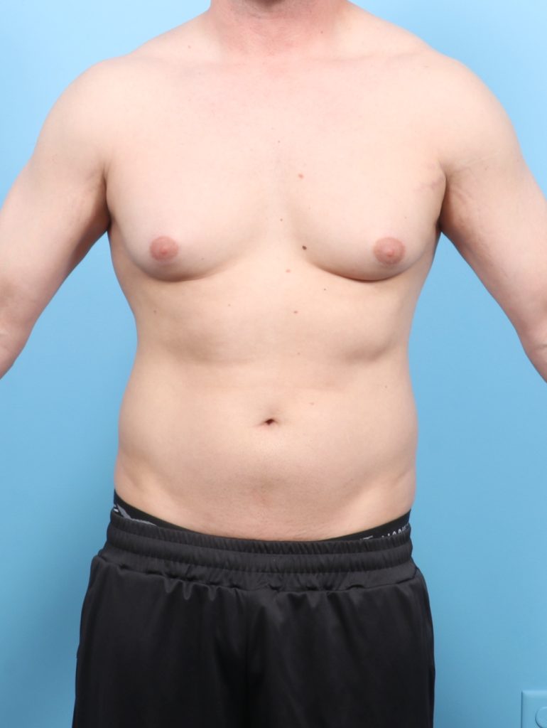 Male Breast Reduction - Case 7527 - Before