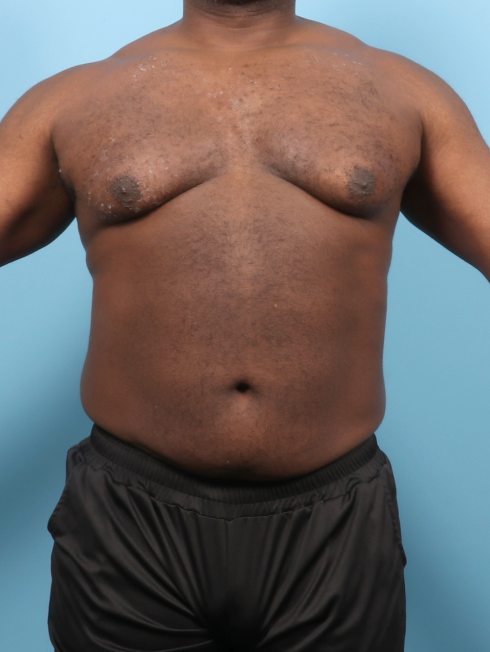 Male Breast Reduction Patient Photo - Case 7543 - before view-