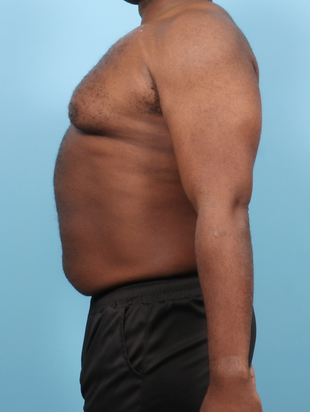 Male Breast Reduction Patient Photo - Case 7543 - before view-2