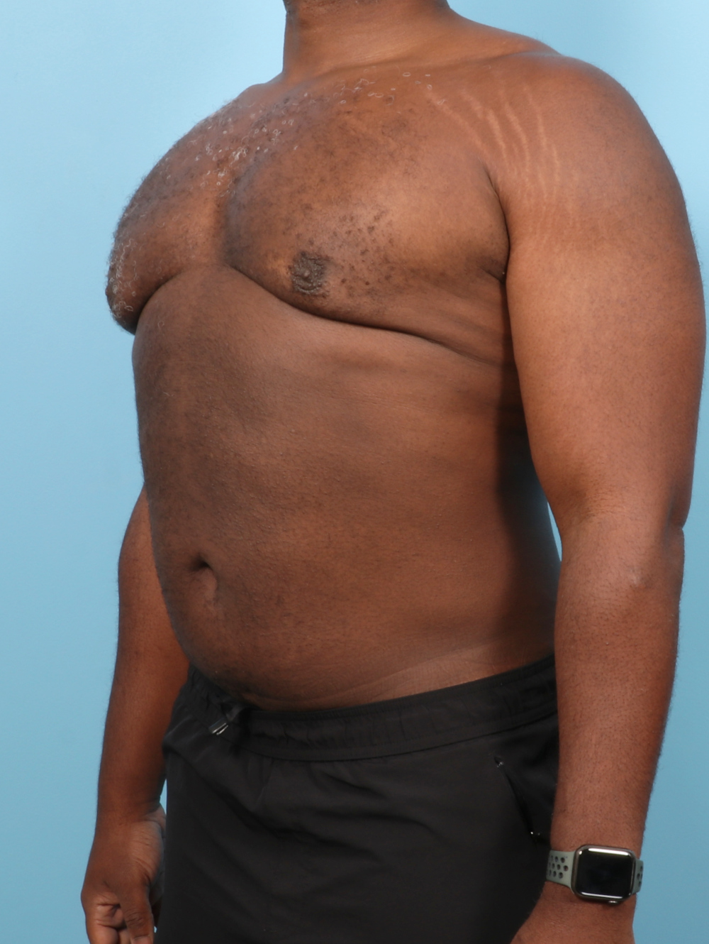 Male Breast Reduction Patient Photo - Case 7543 - after view-1
