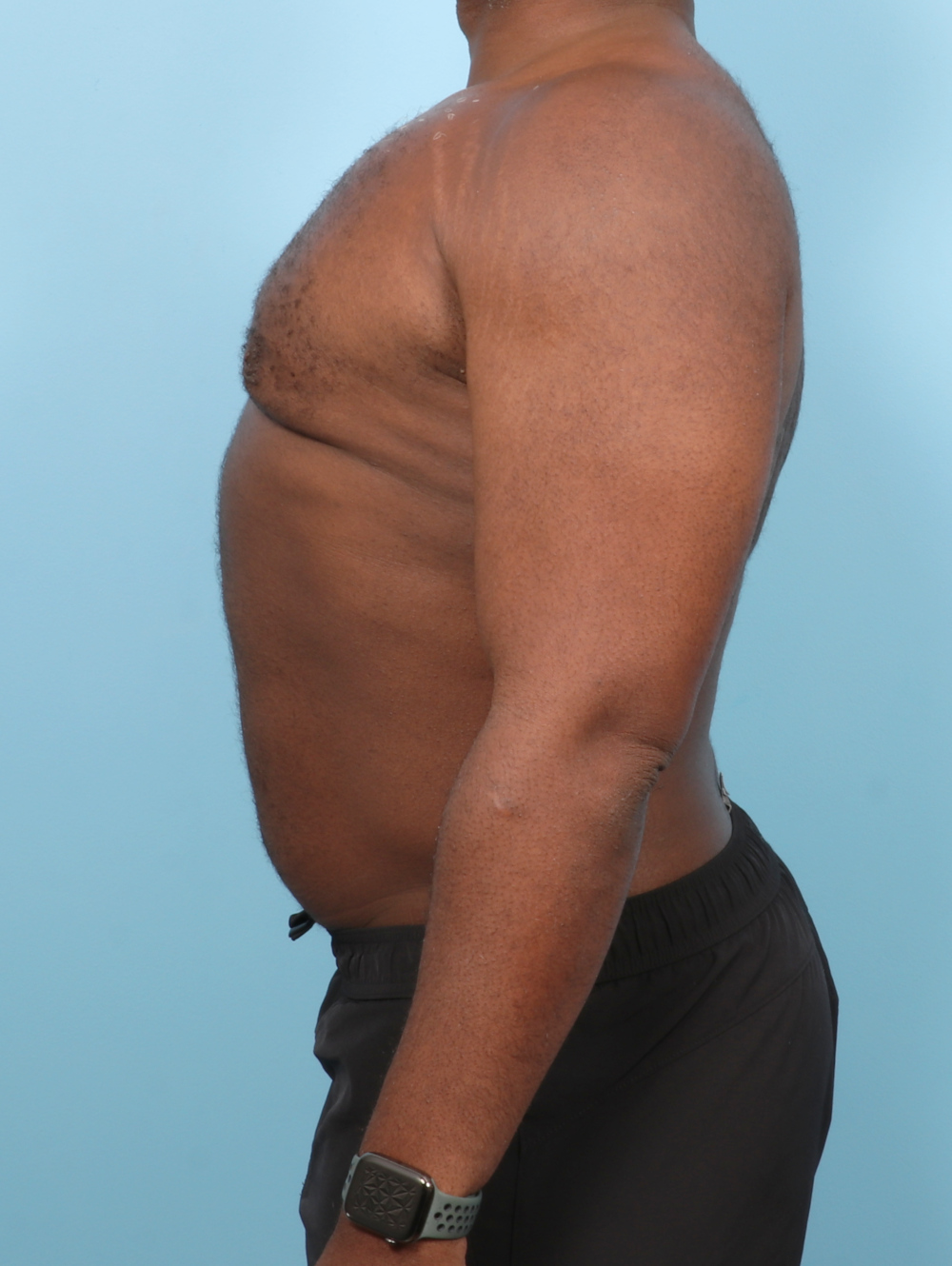 Male Breast Reduction Patient Photo - Case 7543 - after view-2