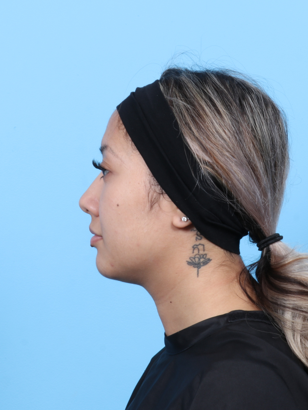 Rhinoplasty Patient Photo - Case 7606 - before view-