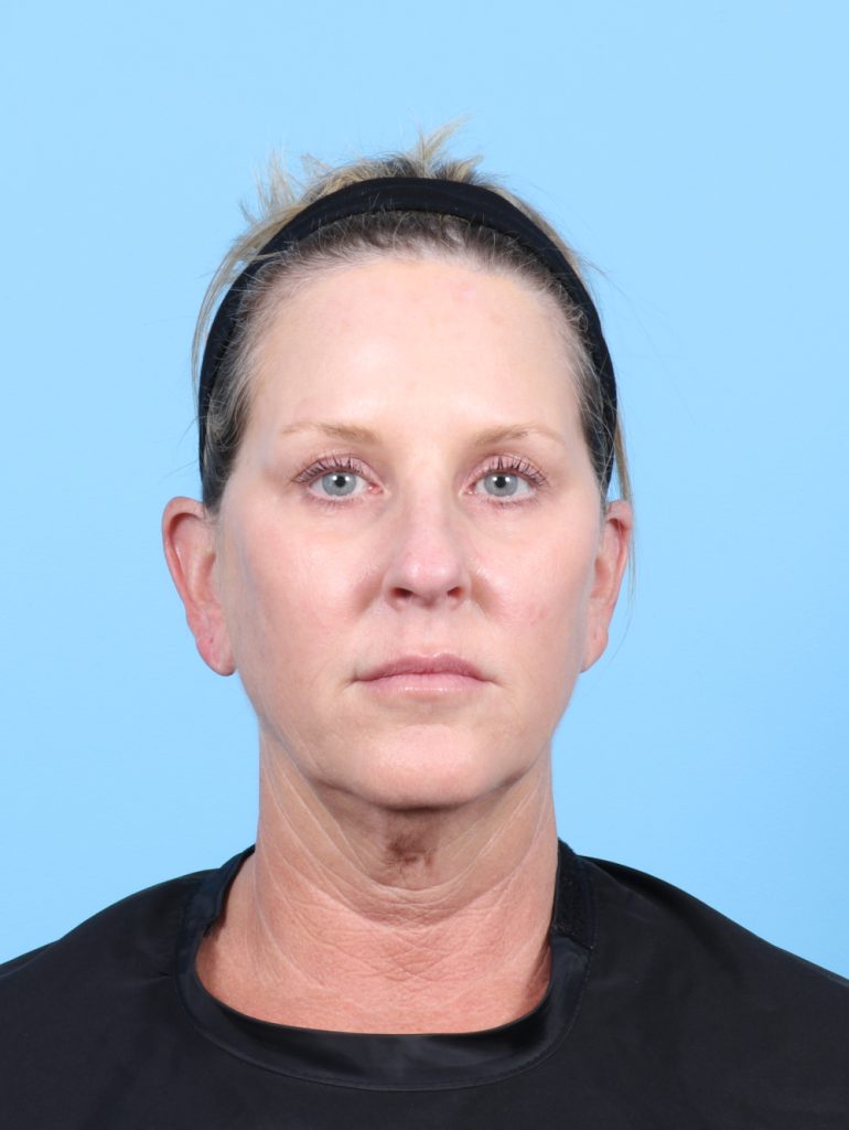 Facelift - Case 7622 - Before