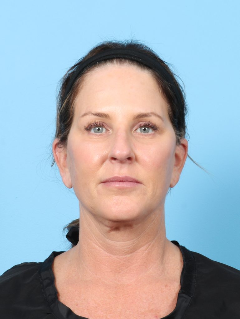 Facelift - Case 7622 - After