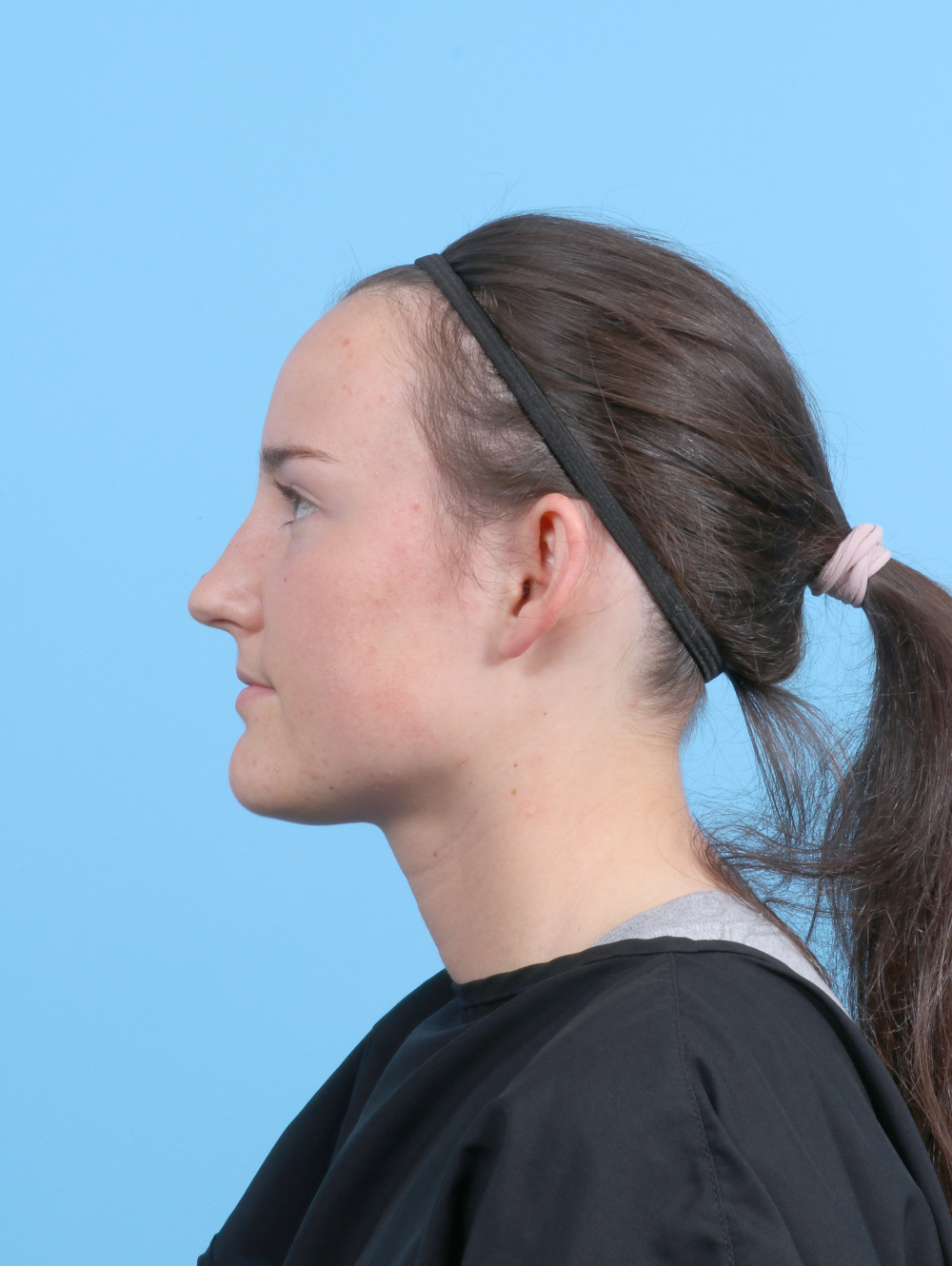 Ear Surgery Patient Photo - Case 7632 - before view-3