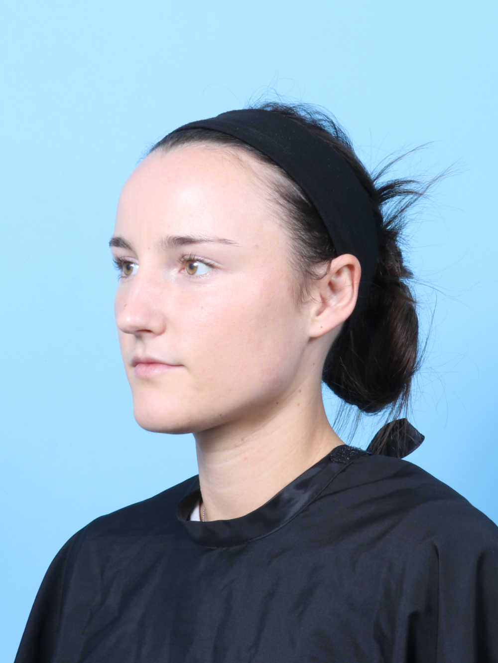 Ear Surgery Patient Photo - Case 7632 - after view-2