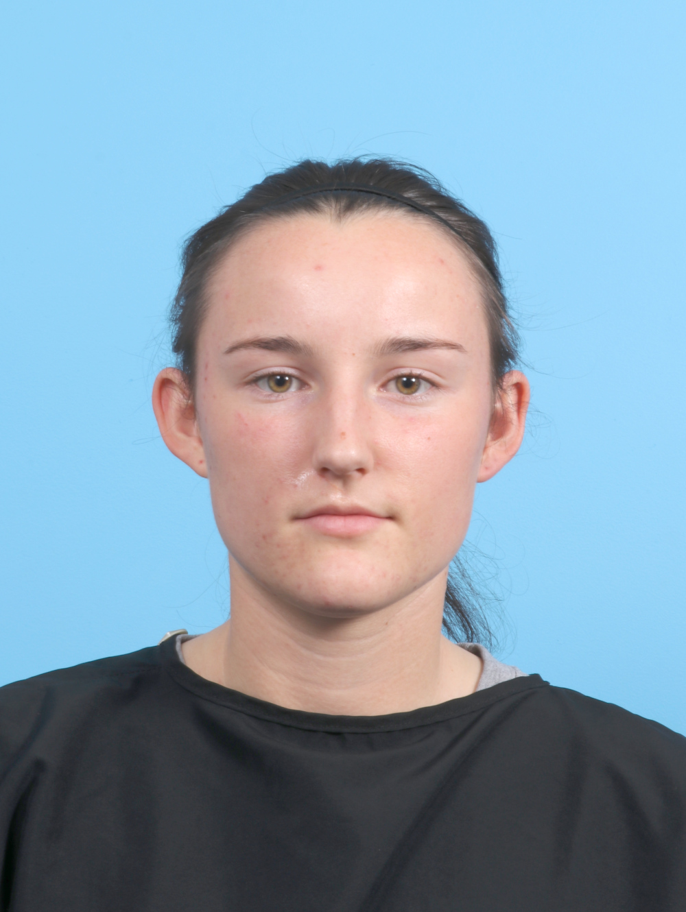 Ear Surgery Patient Photo - Case 7632 - before view-