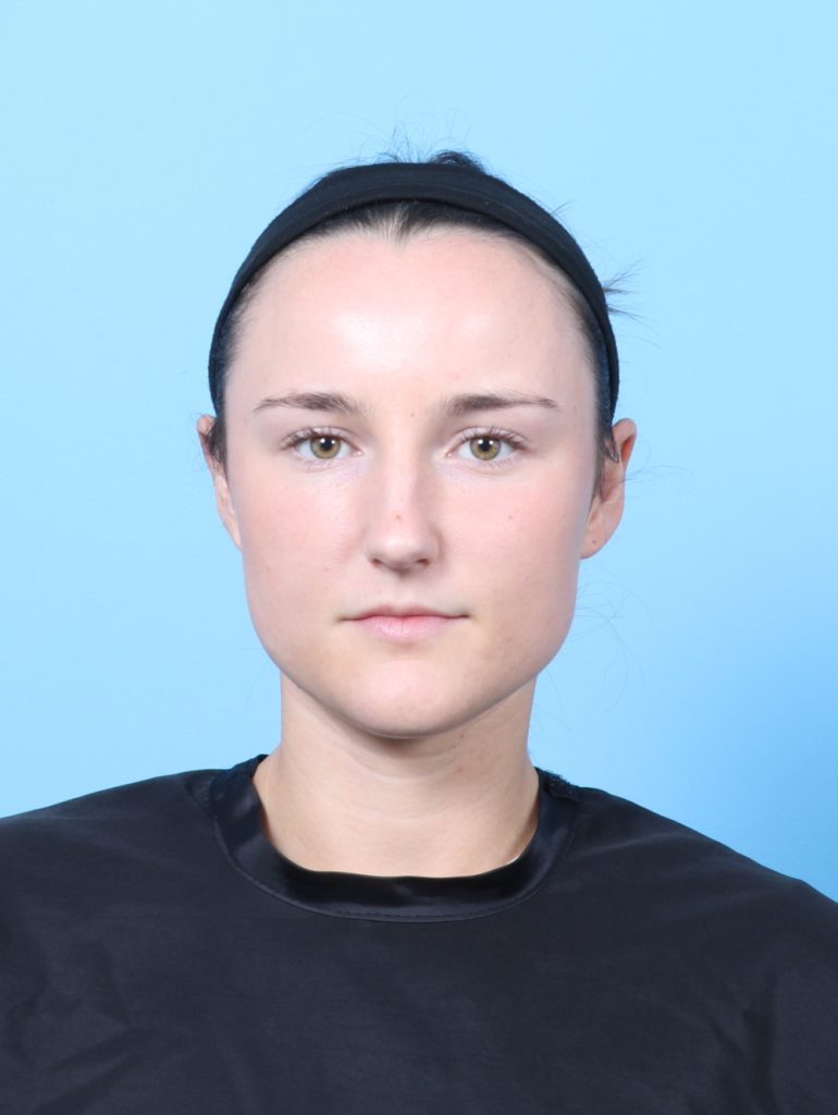 Ear Surgery - Case 7632 - After