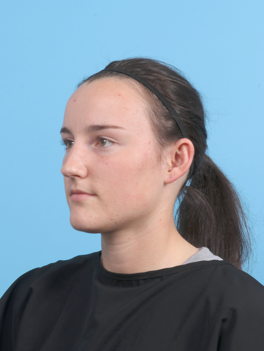 Ear Surgery Patient Photo - Case 7632 - before view-2