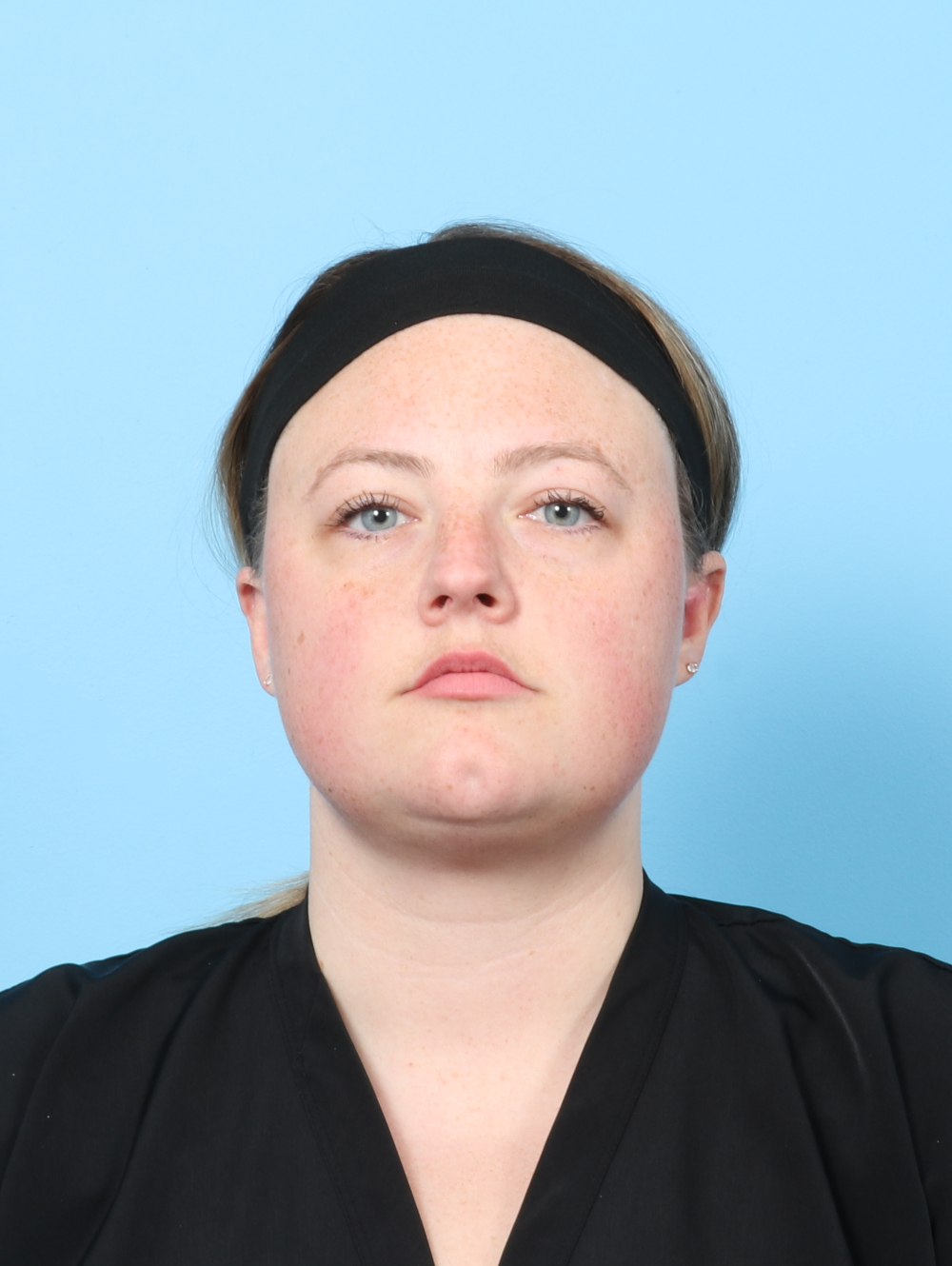 Facial Liposuction Patient Photo - Case 7642 - after view