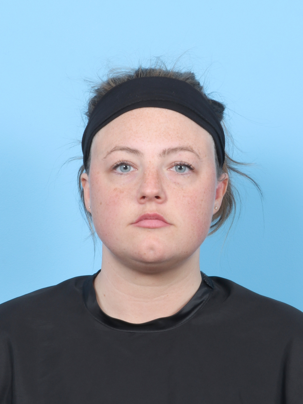 Facial Liposuction Patient Photo - Case 7642 - before view-