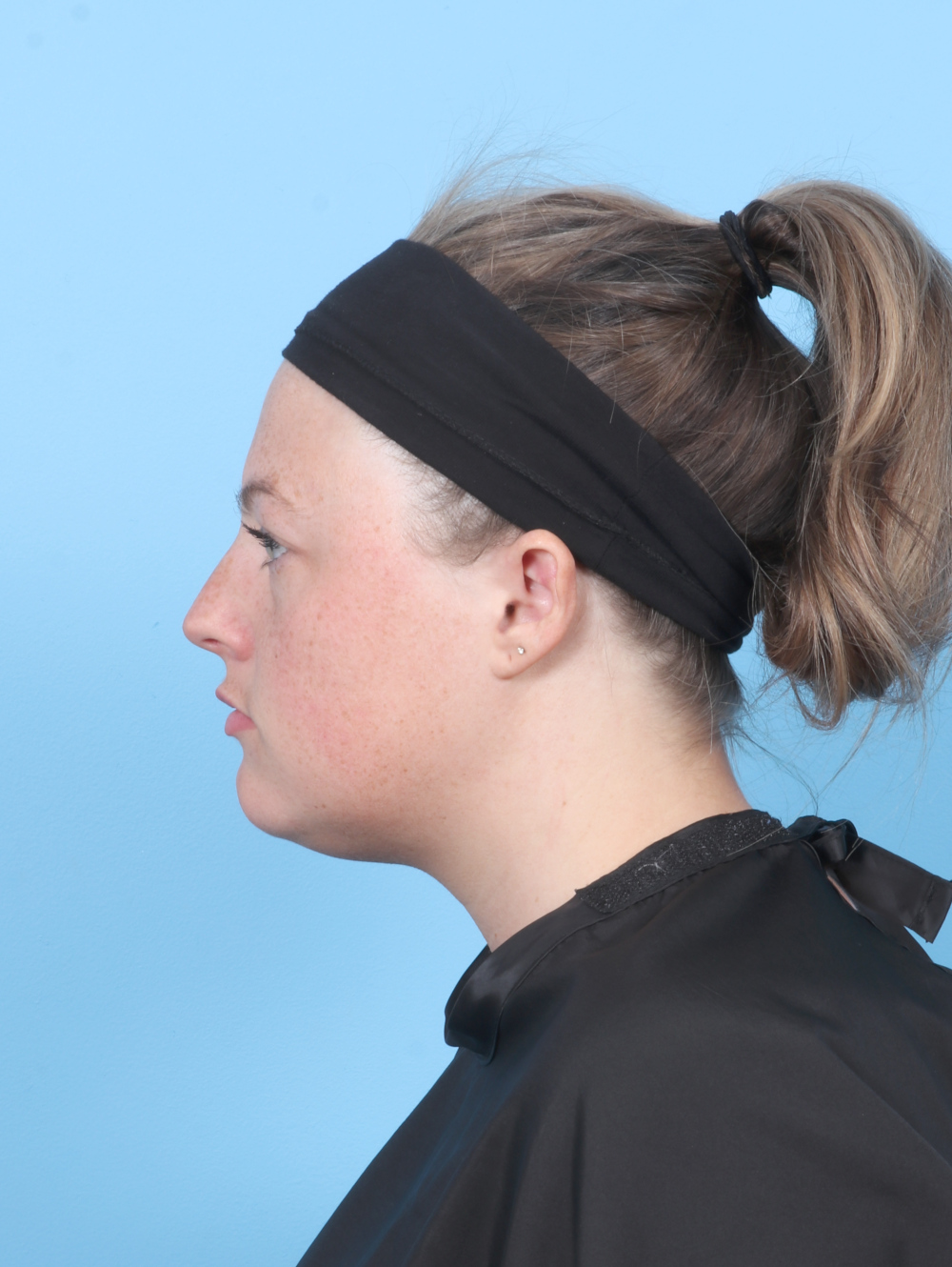 Facial Liposuction Patient Photo - Case 7642 - before view-2