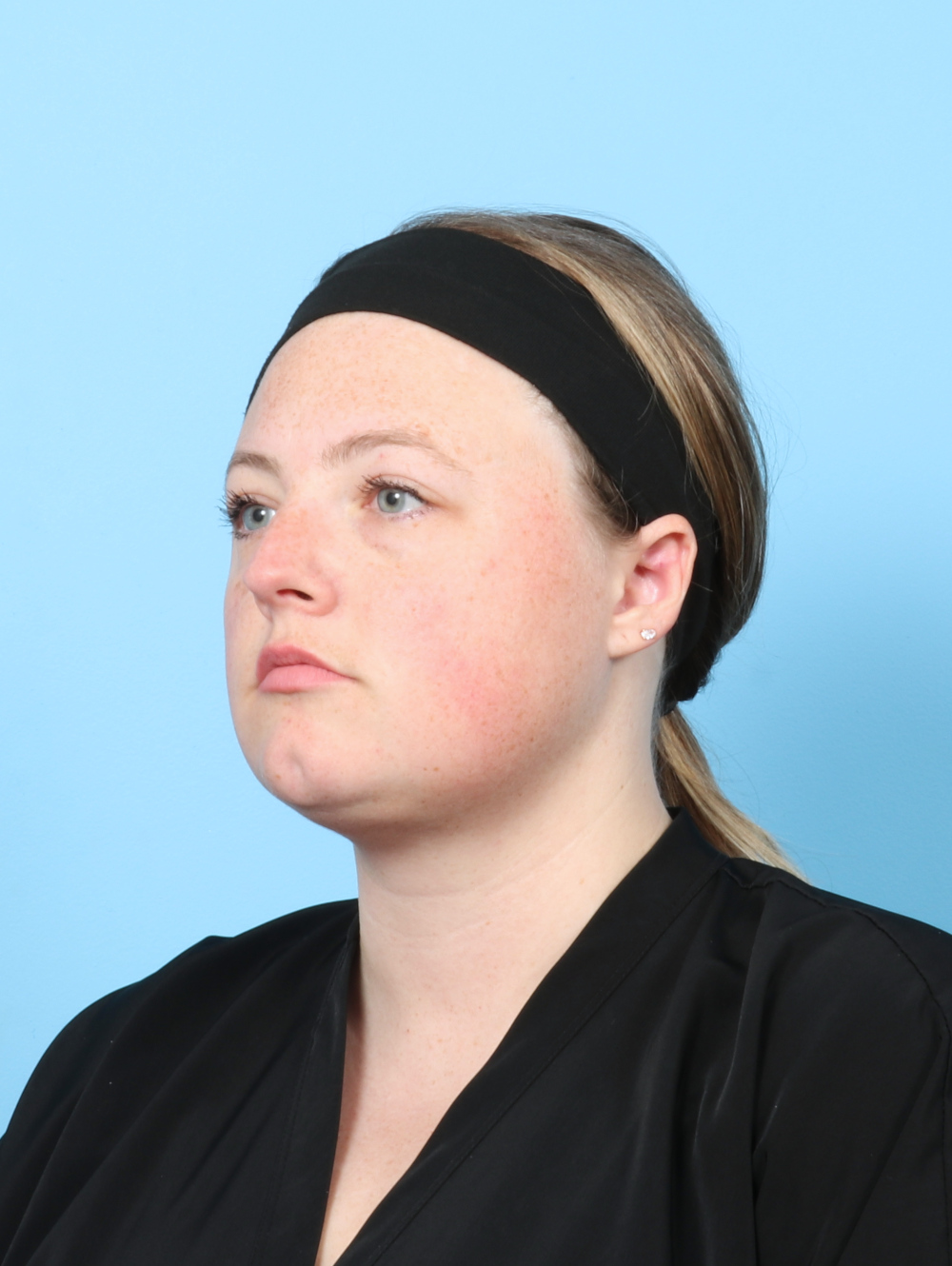 Facial Liposuction Patient Photo - Case 7642 - after view-1