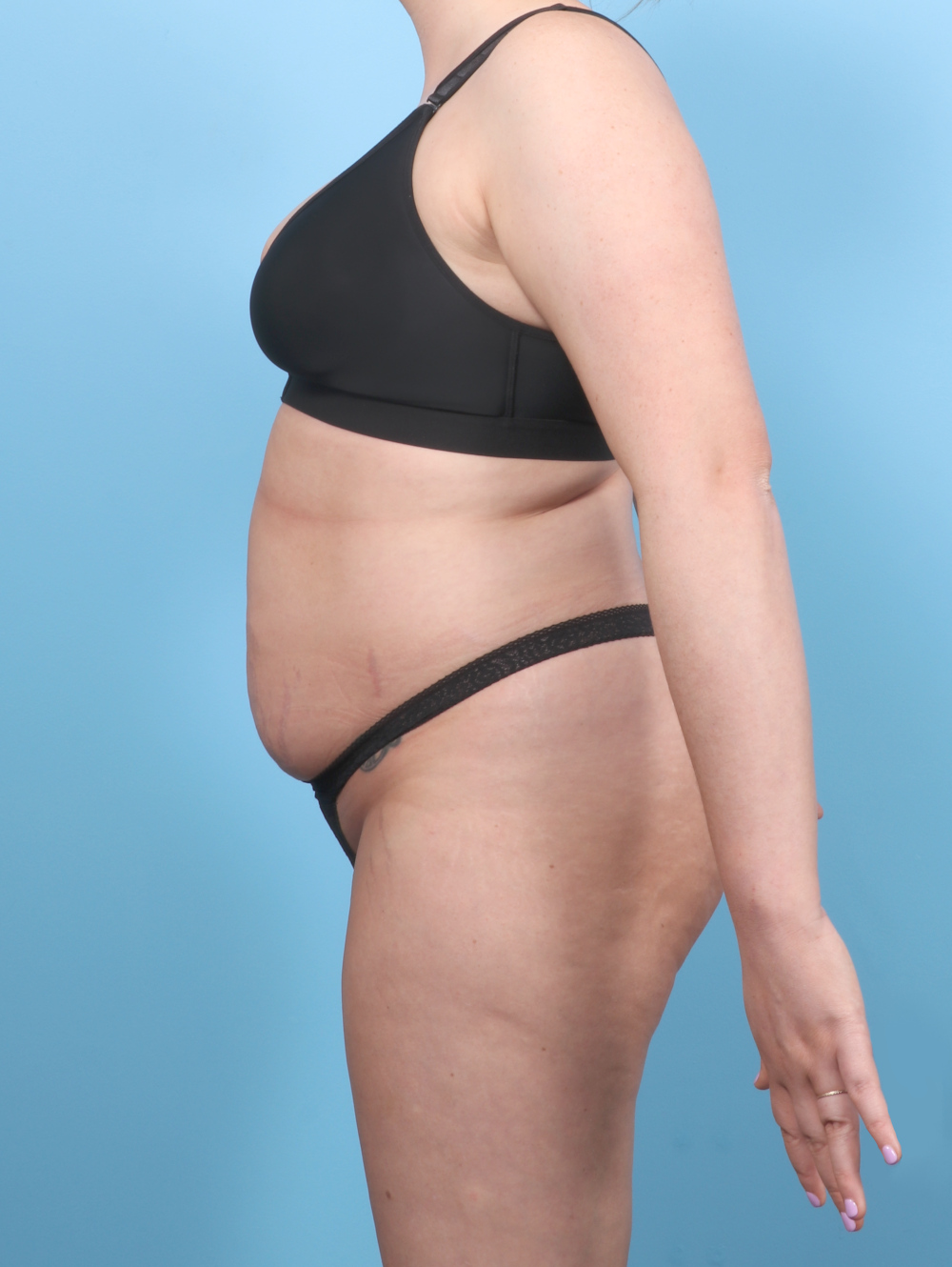 Liposuction Patient Photo - Case 7650 - before view-3