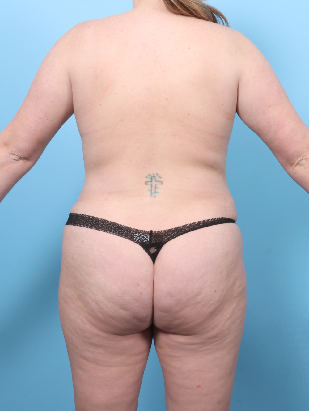 Liposuction Patient Photo - Case 7650 - after view-1