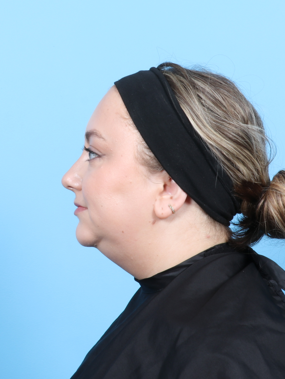 Facial Liposuction Patient Photo - Case 7686 - before view-2