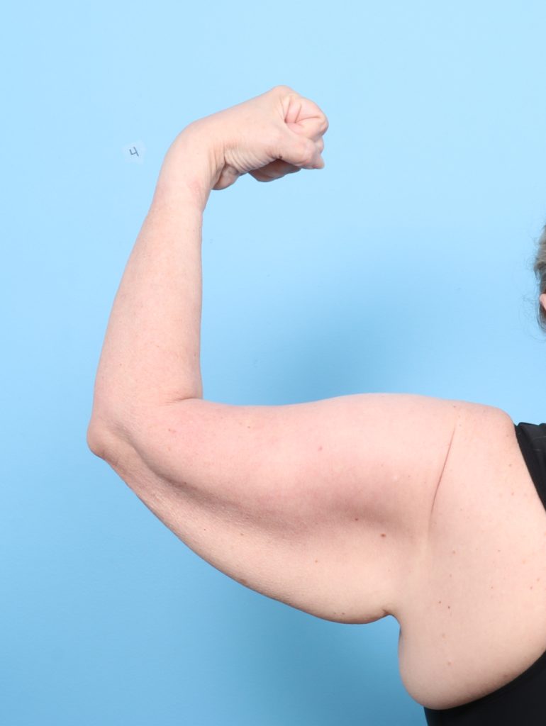 Arm Lift - Case 7694 - Before